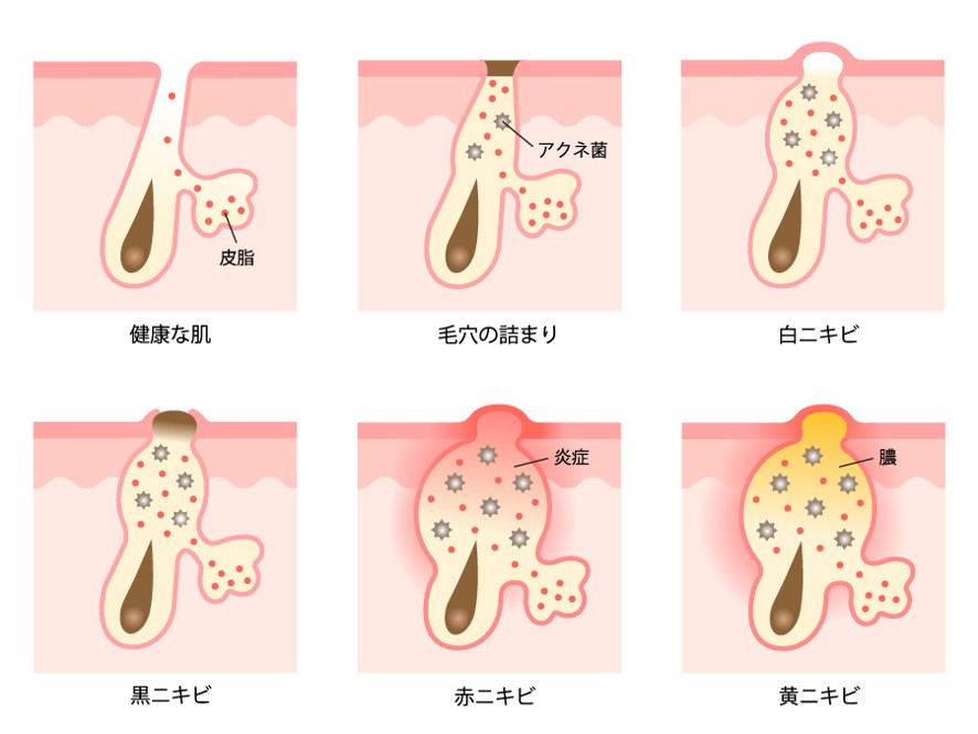 ニキビの種類