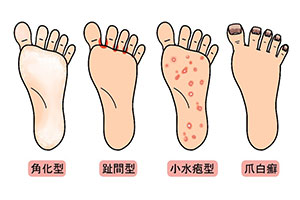 水虫の治療方法